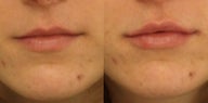 Lip Augmentation