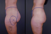 Pure Tumescent Liposuction