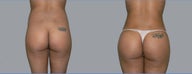 Brazilian Butt Lift to sculpt the waist, enlarge the butt