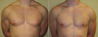 Male Breast Reduction