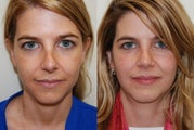Revision Rhinoplasty Surgery. 8 months post-op.