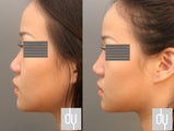 25 year old female before and after nonsurgical rhinoplasty.