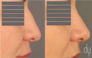 26 year old female before and after revision rhinoplasty.