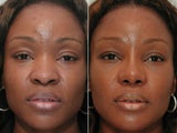 African American Rhinoplasty