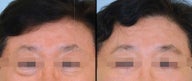 Lower Blepharoplasty