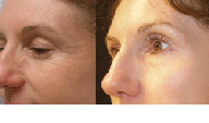 Before & After Portrait Plasma Resurfacing