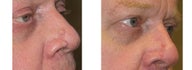 Mole Removal photos