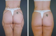 Tumescent Liposuction