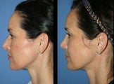 Rhinoplasty