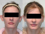 Otoplasty Plastic Surgery