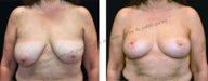 Breast Lift