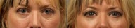 Lower Eyelid Circles Treated with Tear Trough Implants