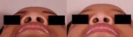 Rhinoplasty