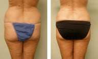 vaser liposuction