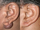 Earlobe Keloid