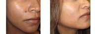 Mole Removal photos