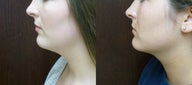22 year old following with excess fat in the submental area and ill defined neck-jaw angle