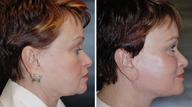 Facelift