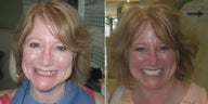 Smile Makeover for a better look