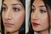 Revision Rhinoplasty. 3 months post-op.