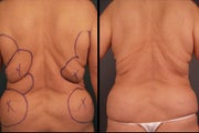 Pure Tumescent Liposuction