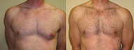 Male Breast Reduction