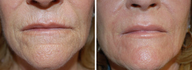 Laser Resurfacing