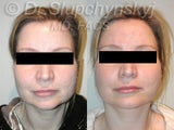 SLUPlift (Mini-lift procedure)