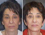 Facelift