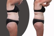 Body-jet liposuction