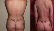 43 Year Old Female with Liposuction and Fat grafting