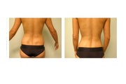 vaser liposuction