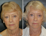 Facelift
