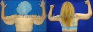 Before and after picture arm lift arm reduction after massive weight loss gastric bypass female back view