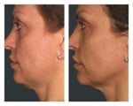 Ultherapy