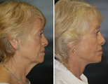 Facelift