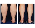 Liposuction