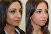 Rhinoplasty Surgery. 2 months post-op.