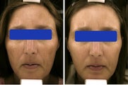 Female treated for Age Spots