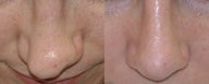 Revision Rhinoplasty