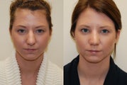Rhinoplasty Surgery. 1 month post-op.