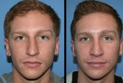 Rhinoplasty