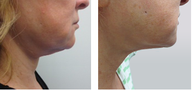 Female Ultherapy for Chin and Neck