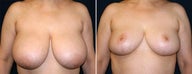 Breast Reduction