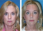 Brow lift (Forehead lift) combined with Facelift