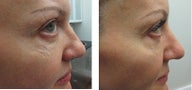 Female Ultherapy Treatment for Eyes