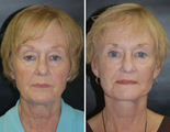 Facelift