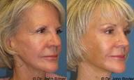 Brow Lift