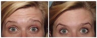 Botox