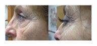 Before and 3 months after Regular Latisse use